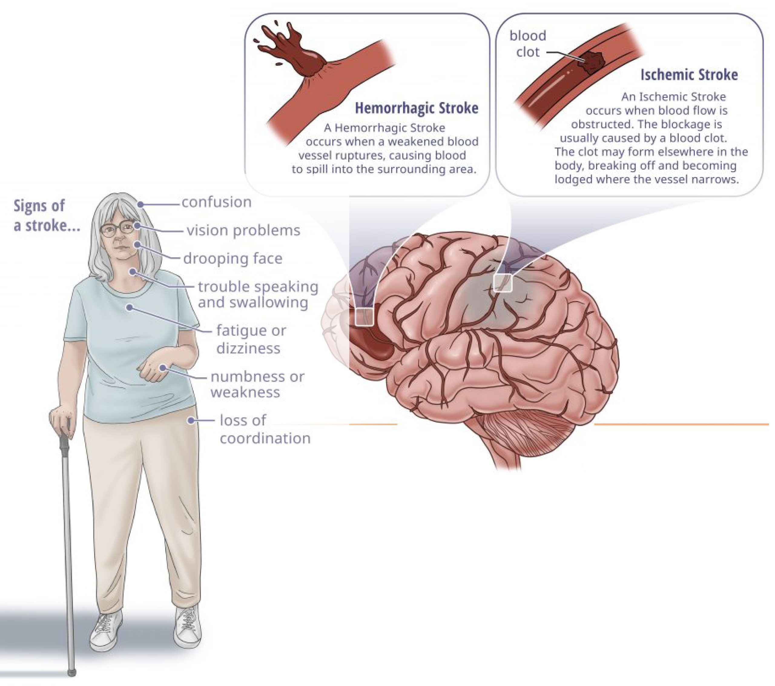 Stroke rehabilitation