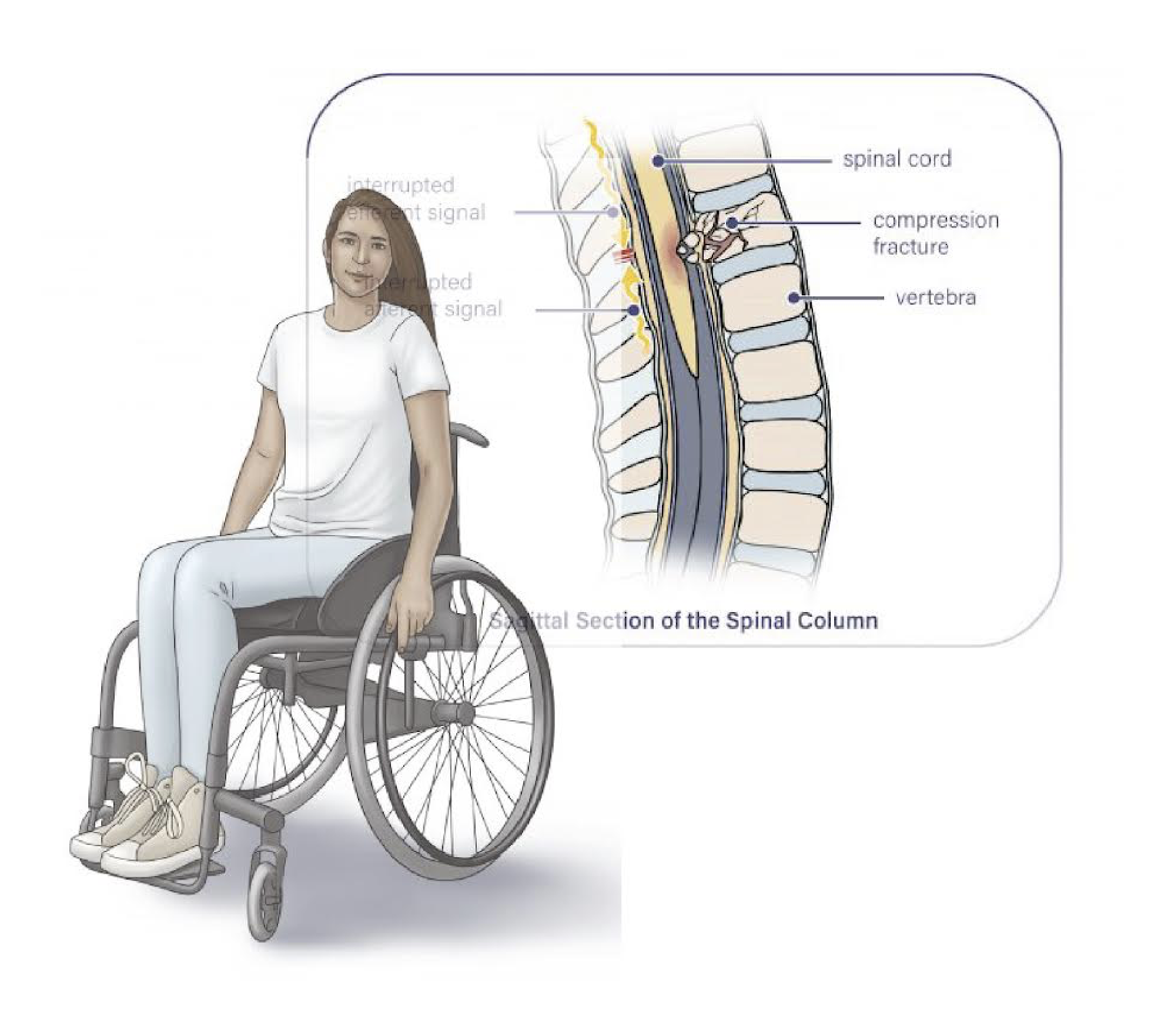 Illustration of spinal cord injury