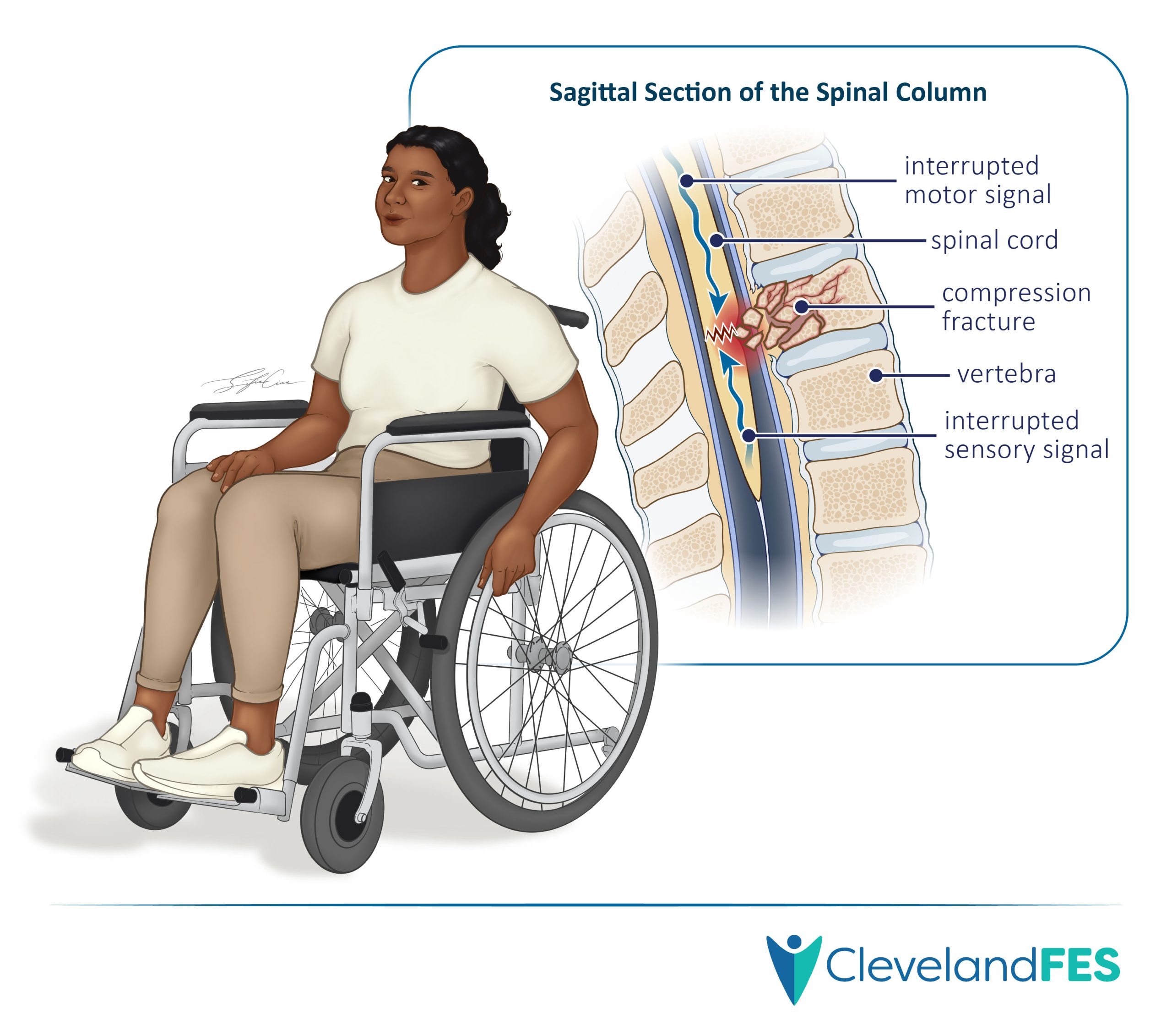Illustration of spinal cord injury