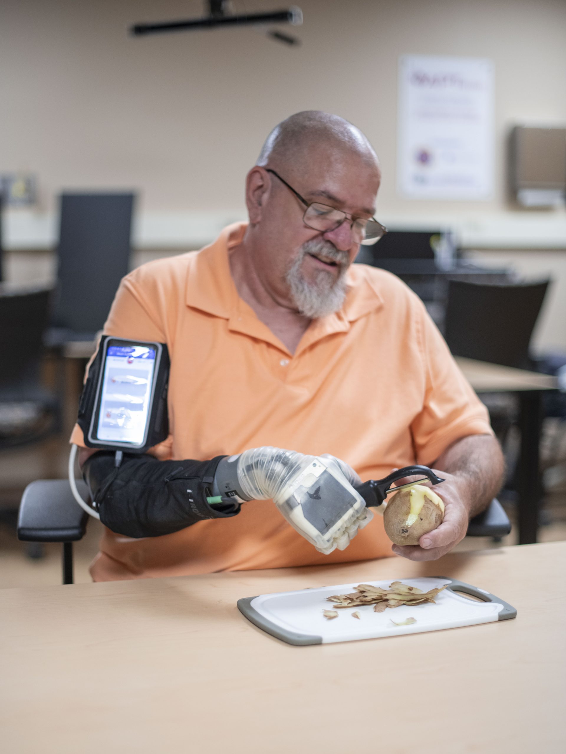 Upper limb prosthesis experience study