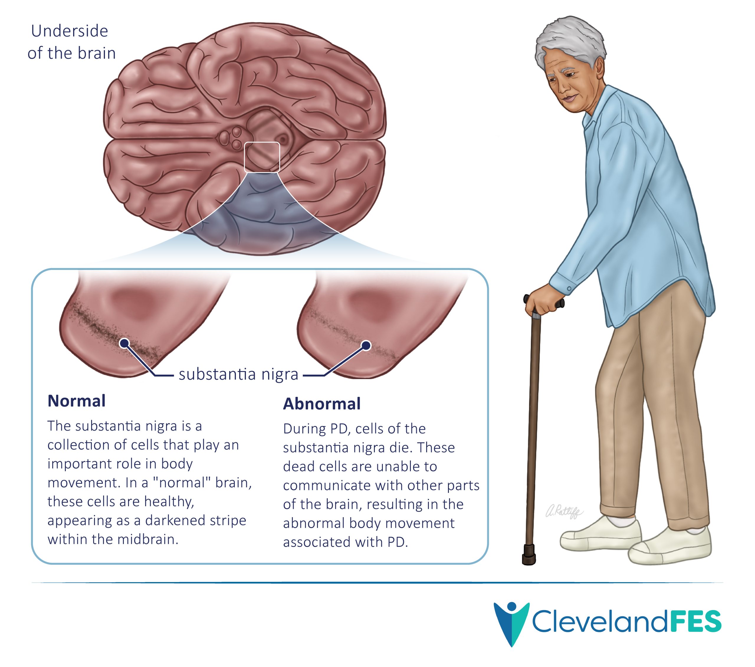 Parkinson's disease treatment illustration