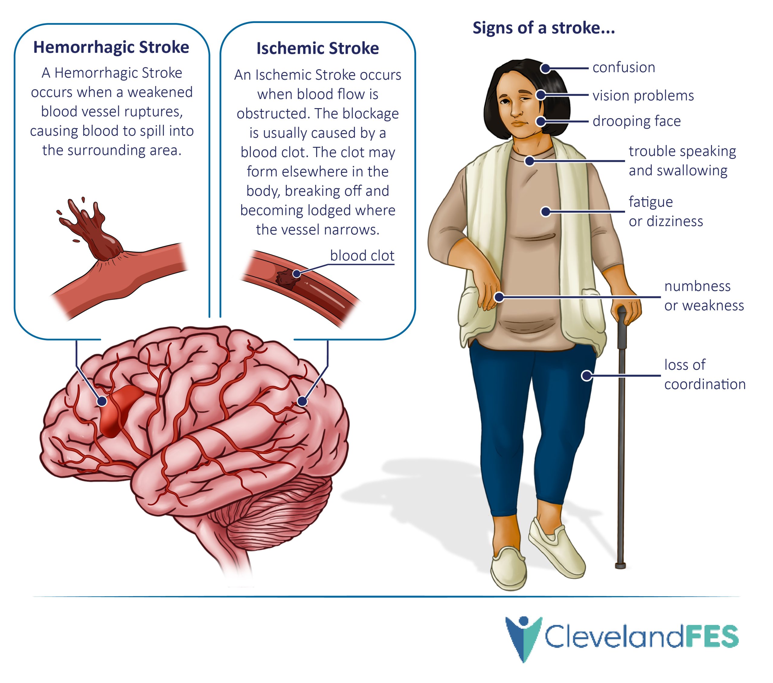 Stroke rehabilitation