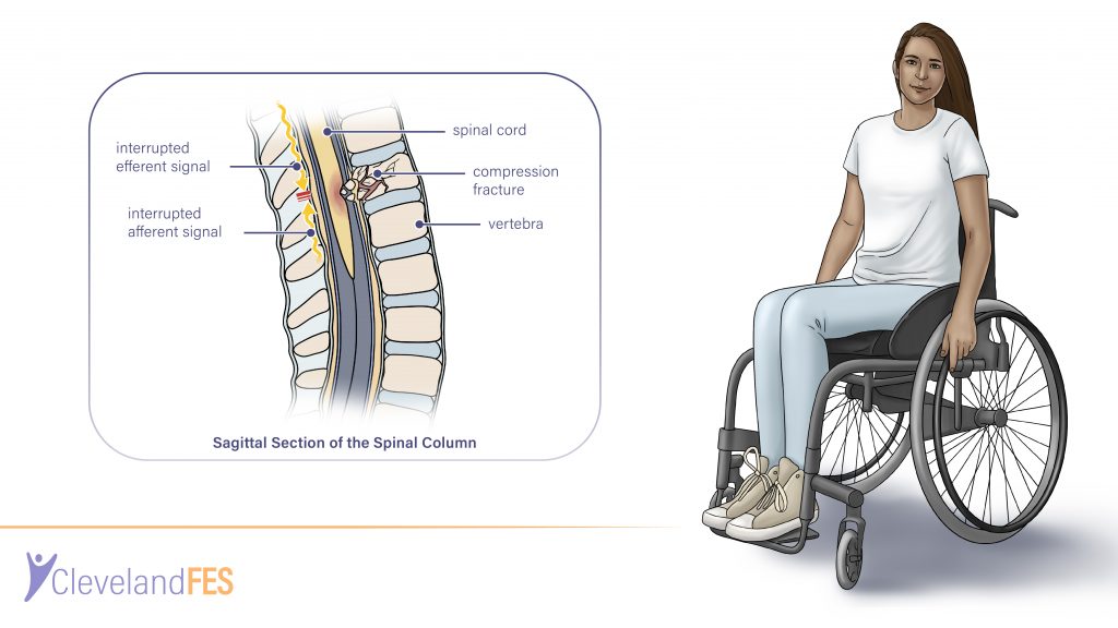 Spinal Cord Injury Cleveland FES Center