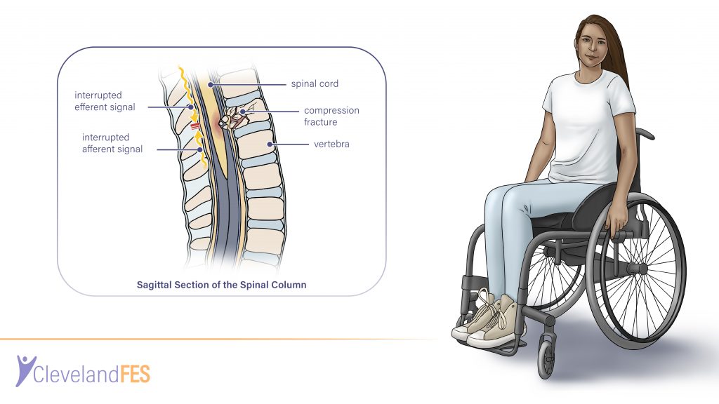 Feedback improves compliance of pressure relief activities in wheelchair  users with spinal cord injury