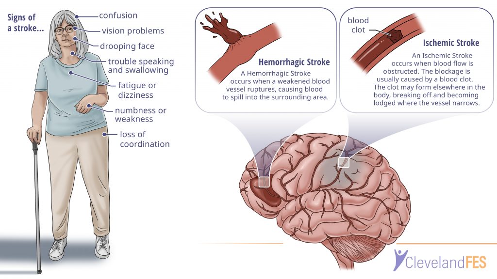 stroke case study physiopedia