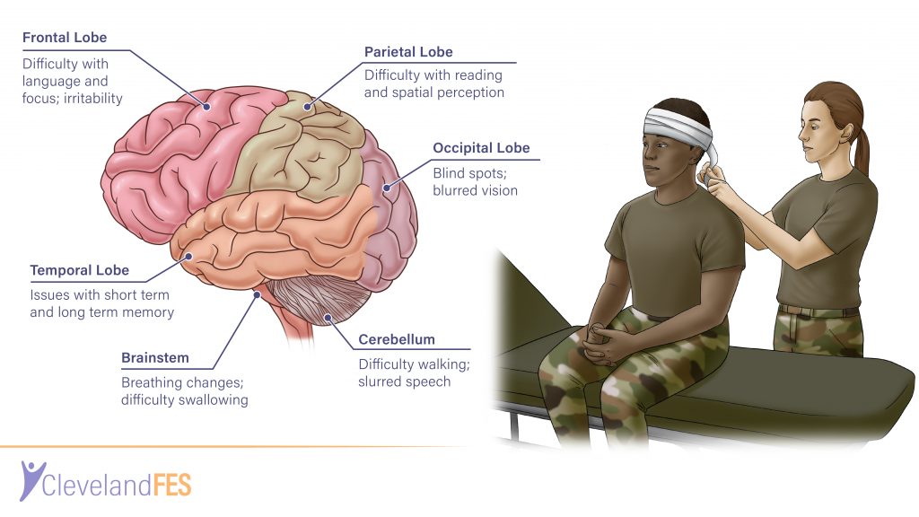 Seizure Brain Damage